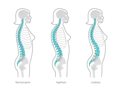 Spinal Deformities