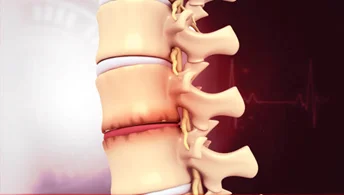 Degenerative Disc Disease
