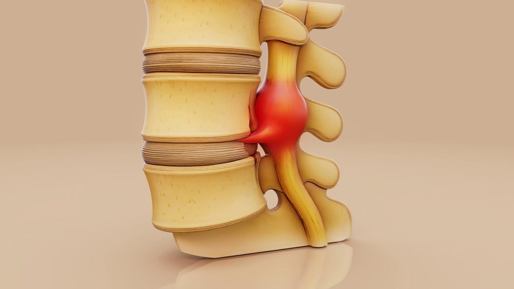 Spinal Stenosis