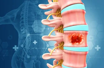 Spinal Tumors