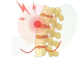 Arthritis of the Spine