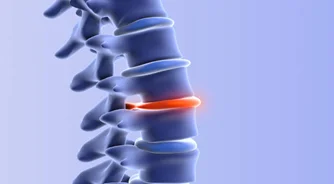 Herniated Discs