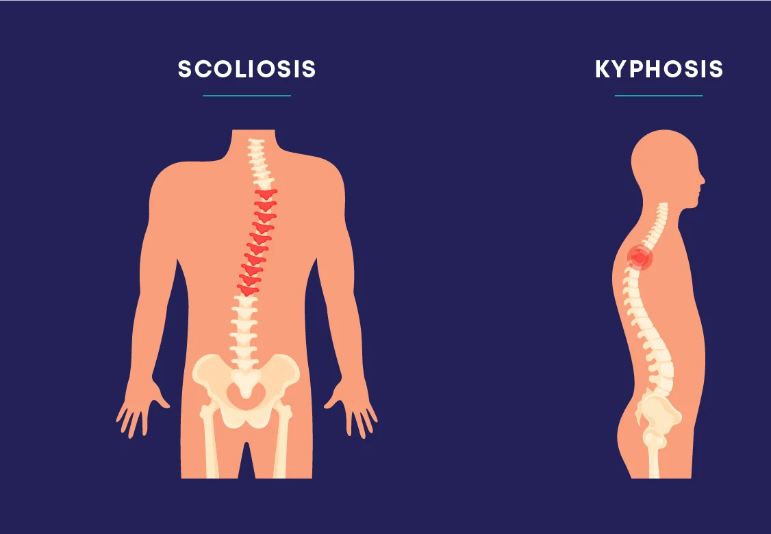 Scoliosis