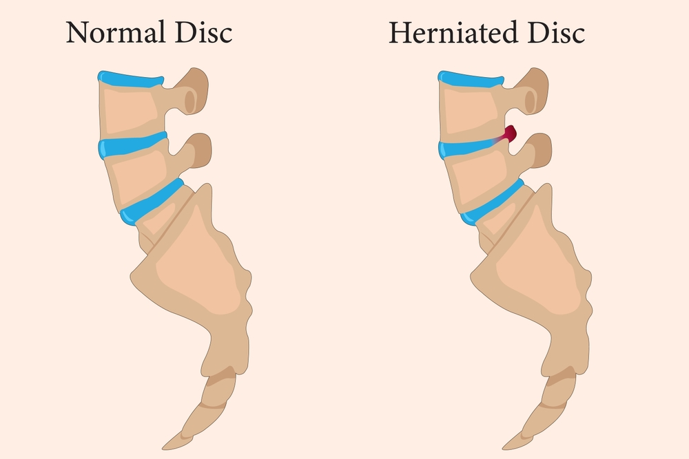 Slip Disc / Herniated Disc