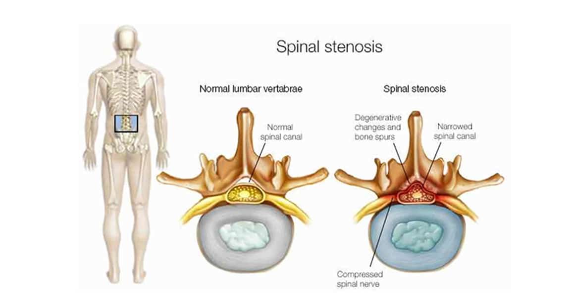 lumbar-spine-stenosis.jpg