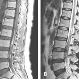 Spinal Hematoma