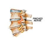 Spinal Nerve Entrapment