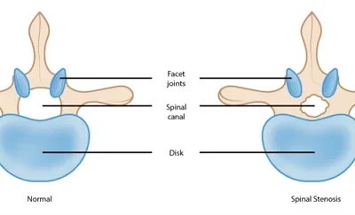 Lumbar Spine Stenosis