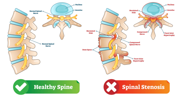 Cervical-Spinal-Stenosis.png