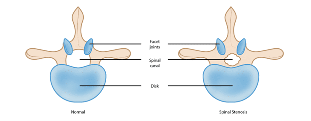 Lumbar-Spine-Stenosis.png