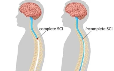 Difference Between Complete SCI and Incomplete SCI
