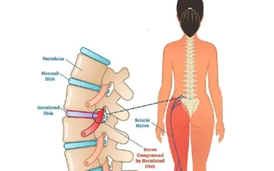 Does Spinal Stenosis Cause Sciatica Nerve Pain?