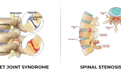 Facet Joint Syndrome vs. Spinal Stenosis