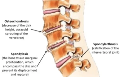 Spinal Osteochondritis