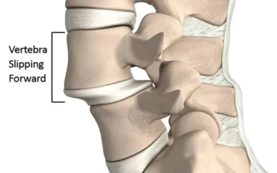 Spondylolisthesis Lumbar Spine