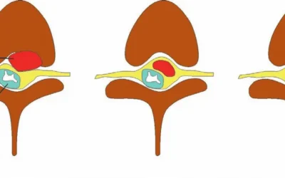 Types of Spinal Tumors