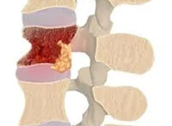 Vertebral Osteomyelitis
