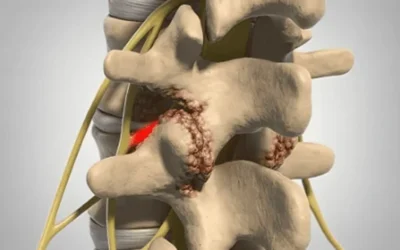 Degenerative disc with osteophyte formation