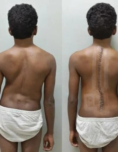 Spinal correction before and after