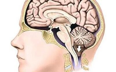Chiari Malformation