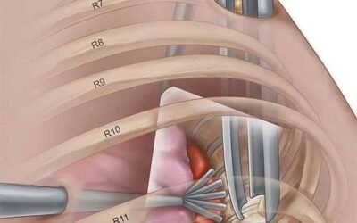 Herniated Disc Surgery