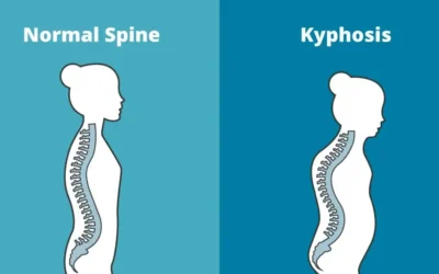 Kyphosis