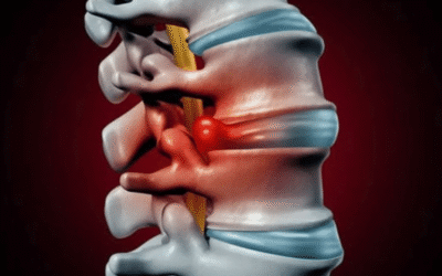 Herniated Disc