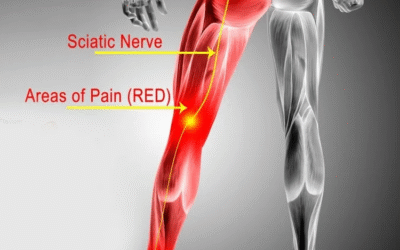 Sciatica
