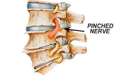 Spinal nerve entrapment