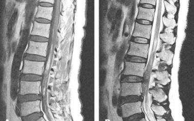 Spinal Hematoma