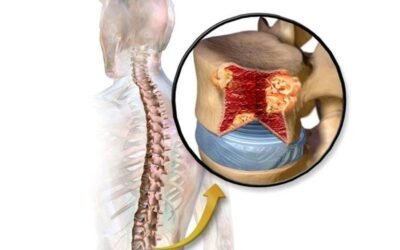 Spinal Tumors