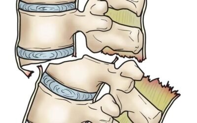 Vertebral fractures