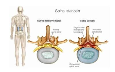 Lumbar Spine Stenosis