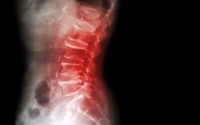 Spinal Infections