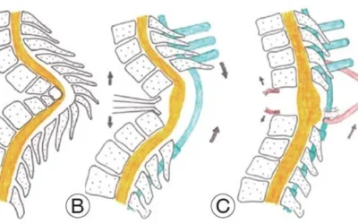 Vertebral Column Resection