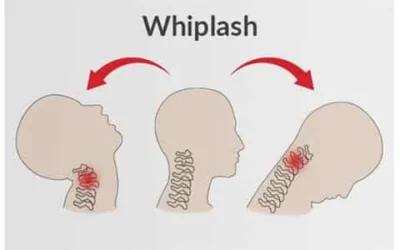 Whiplash Injury