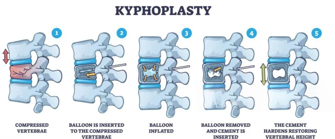 Stepwise kyphoplasty: compressed vertebra, balloon insertion, balloon inflated, cement injected, cement hardening restores height.