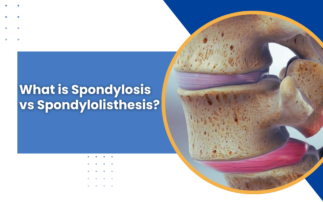 What is Spondylosis vs Spondylolisthesis