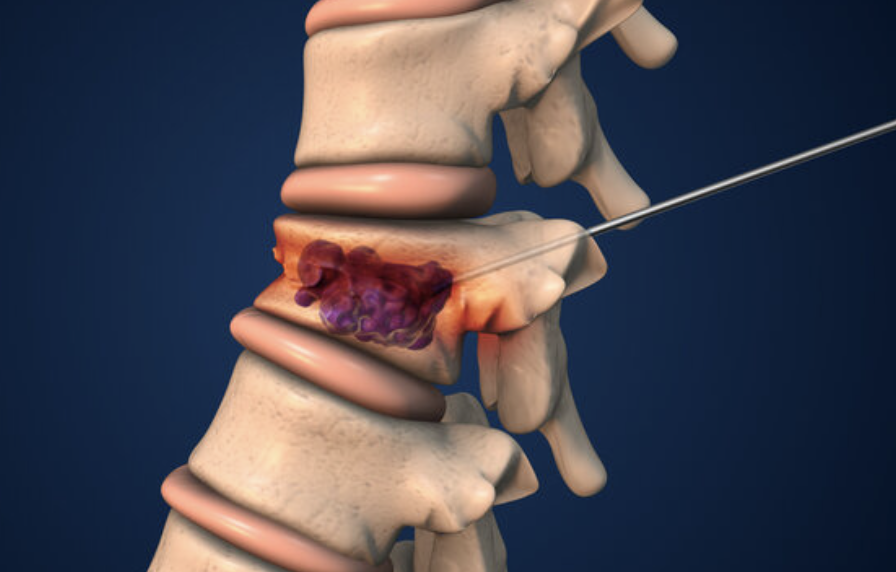 Side view of a spinal segment showing a herniated disc with a needle/device approaching the site for treatment or biopsy.