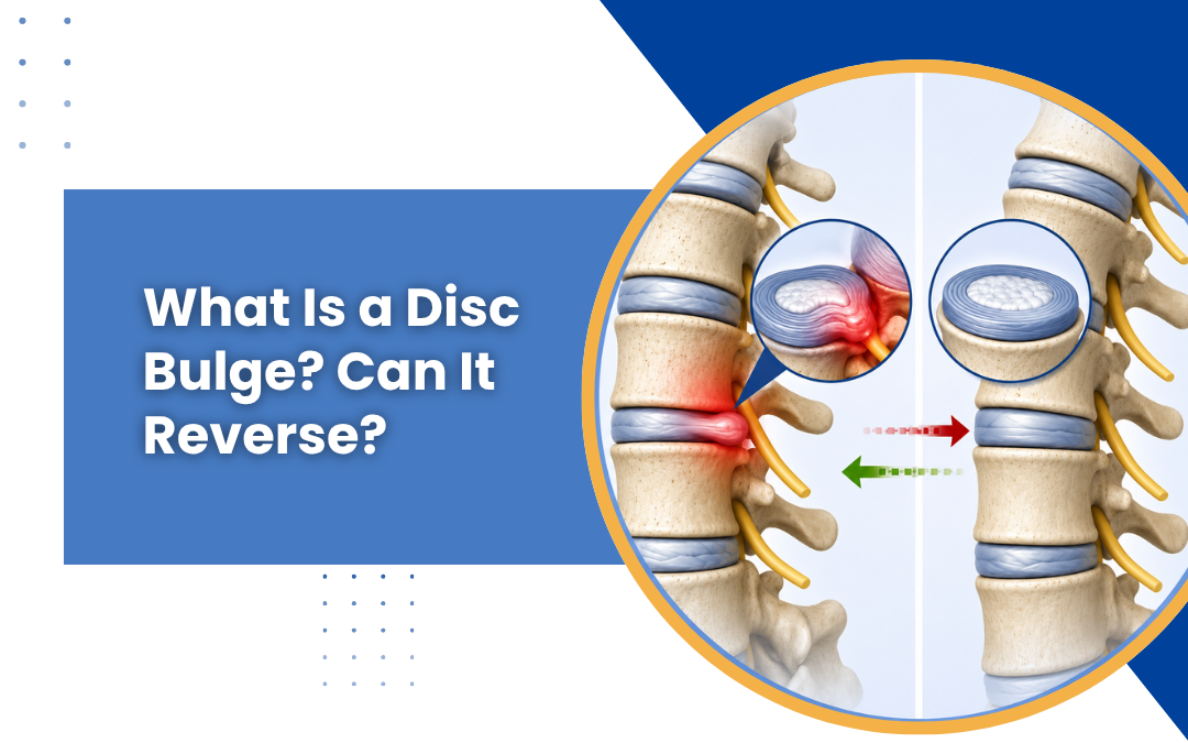 What Is a Disc Bulge? Can It Reverse?