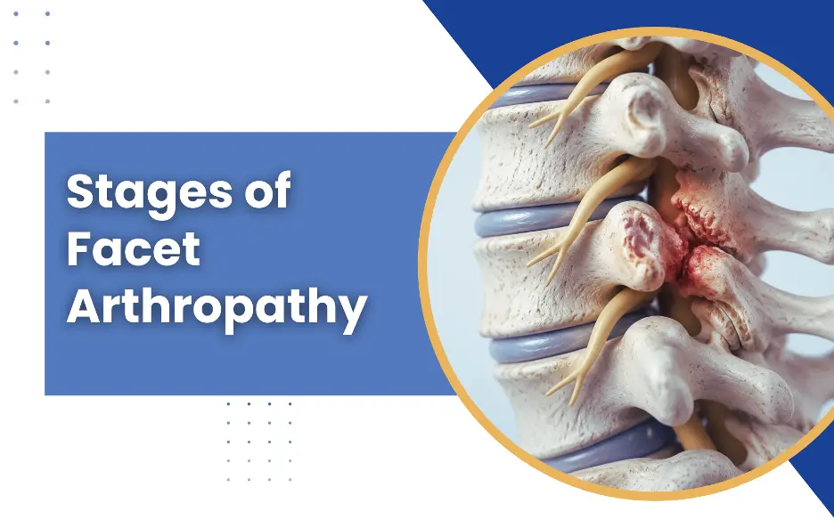 Stages of Facet Arthropathy