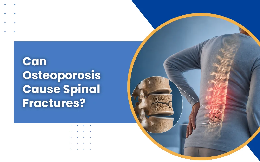 Can Osteoporosis Cause Spinal Fractures?